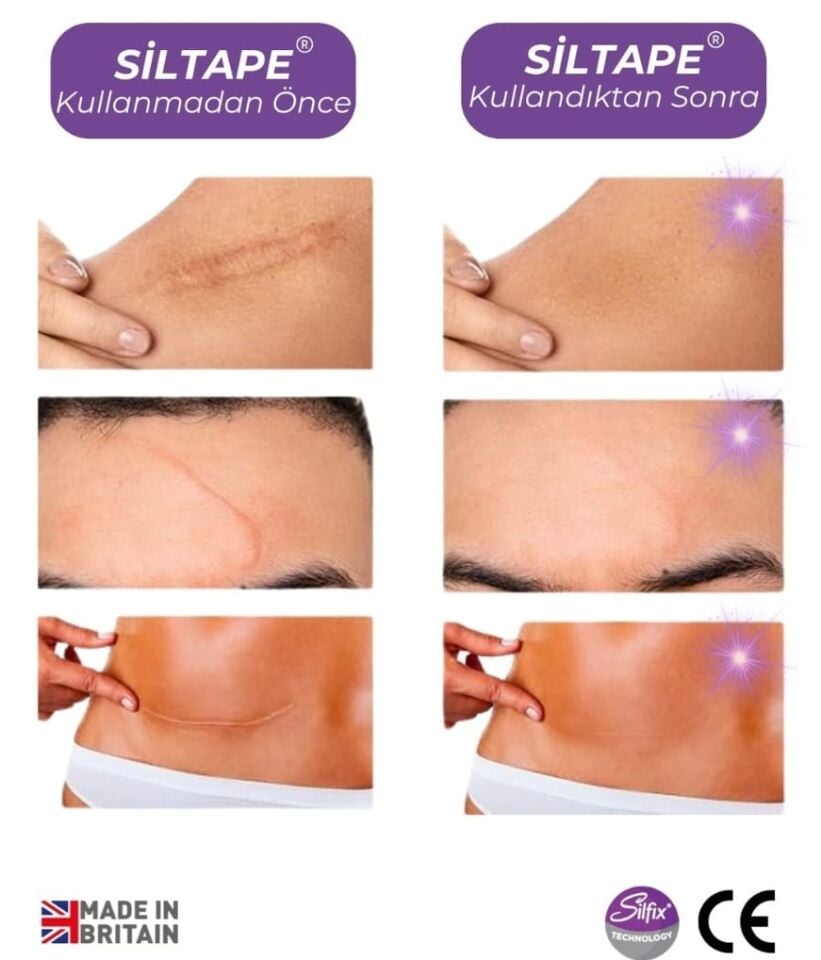 Siltape Soft Silikon Yara İzi Dikiş İzi Sezaryen Yanık Estetik Bant 2cmx3mt